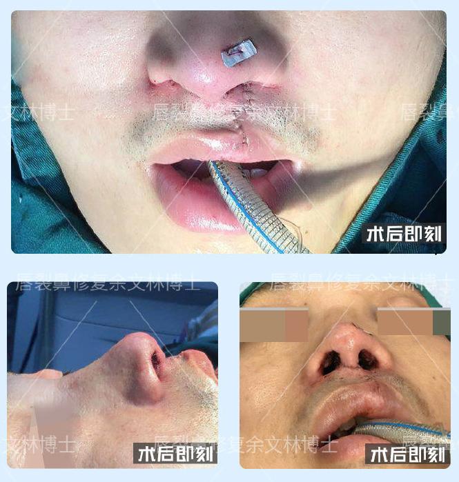 鼻部整形修复，重塑自信的美丽之旅