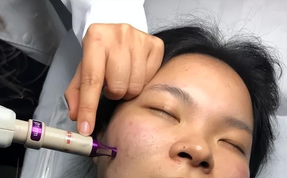 像素激光祛疤，重塑肌肤的微光奇迹