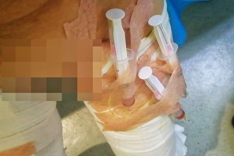 腿部吸脂，价格、考量与选择