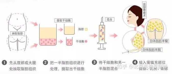 探索美丽新境界，自体脂肪注射丰胸的奥秘与魅力